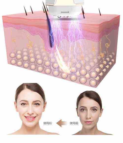 使用美容仪有副作用吗（使用美容仪有依赖性） 第9张