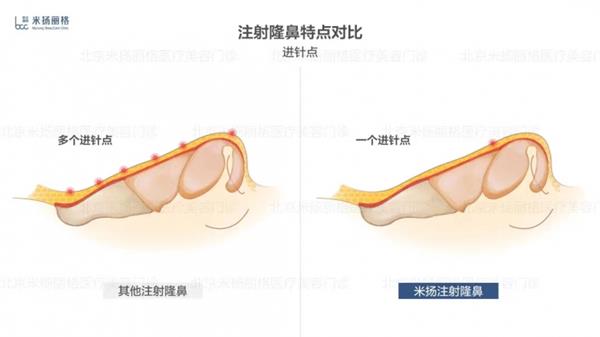 北京米扬丽格李振医生在鼻部注射和轮廓塑形方面的技术应用 第4张