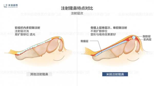 北京米扬丽格李振医生在鼻部注射和轮廓塑形方面的技术应用 第5张