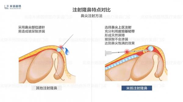 北京米扬丽格李振医生在鼻部注射和轮廓塑形方面的技术应用 第8张