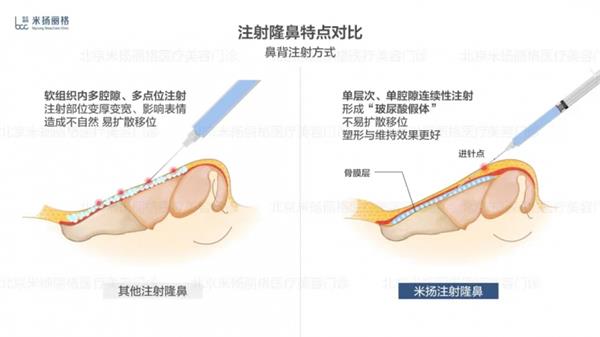 北京米扬丽格李振医生在鼻部注射和轮廓塑形方面的技术应用 第6张