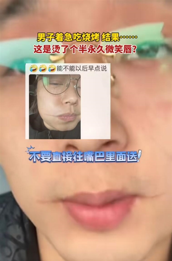 男子吃烧烤被烫出微笑唇：忽略了烤肉的铁签子温度高 第2张