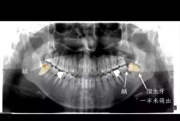 男子一次拔牙23颗后不幸离世 一次只能拔一颗吗？ 第2张
