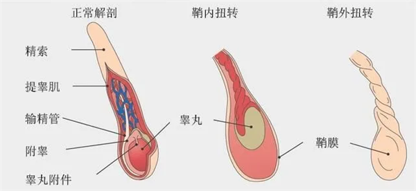 18岁小伙骑车5小时单侧睾丸被切除：扭转360度 缺血坏死 第2张